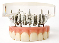 implant-supported dentures
